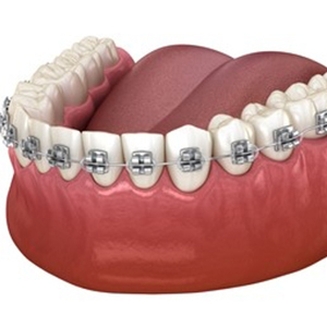 Dental Braces in karimnagar