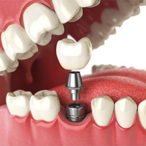 Dental Implants in karimnagar