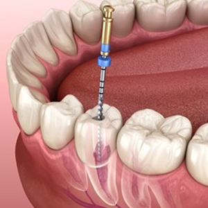 Root Canal Treatment in karimnagar